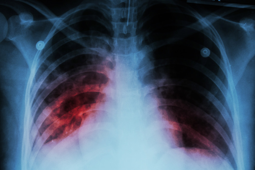 Pulmonary tuberculosis (TB): Chest x-ray show alveolar infiltration at both lung due to mycobacterium tuberculosis infection. Source: Tuchong.