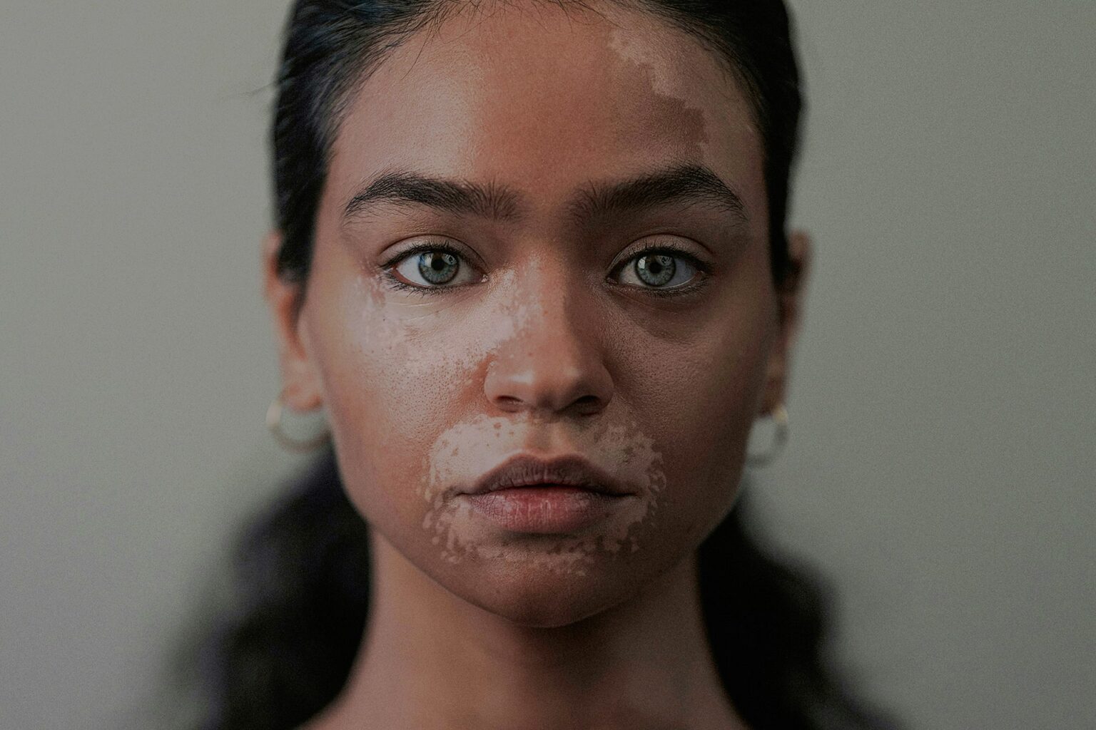 Dermatology spinoff Dermavon files for IPO, with vitiligo drug as standout bet