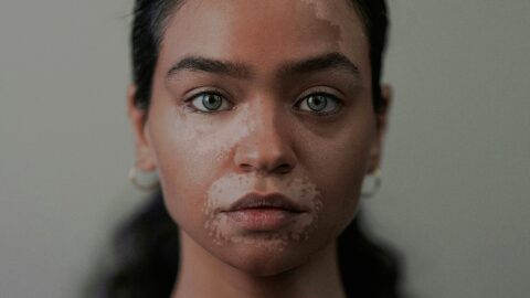 Dermatology spinoff Dermavon files for IPO, with vitiligo drug as standout bet